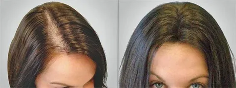 How to fix areas where the hairline density is thin on top amongst older wigs.